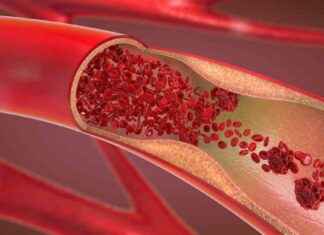 Verstopfte Gefäße: Häufig übersehenes Gesundheitsrisiko in Deutschland news-16092024-125443